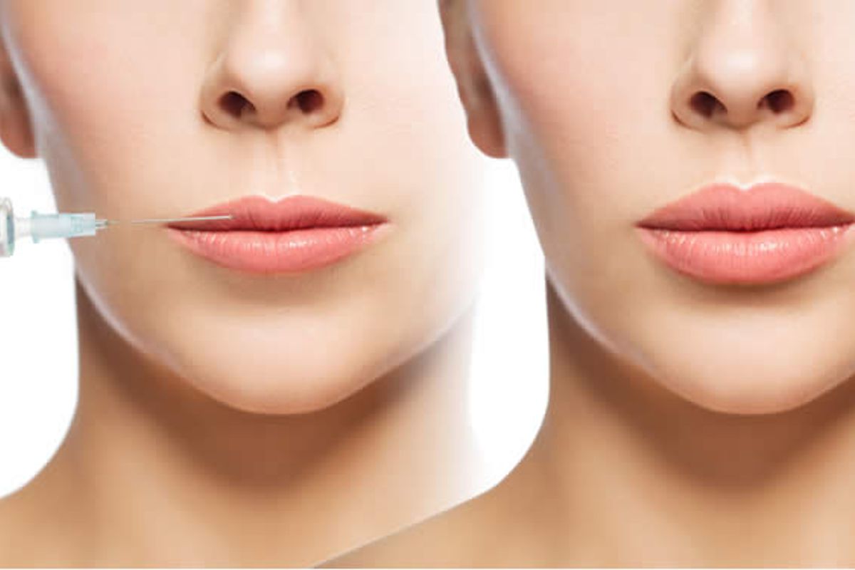https://www.mauriziopaiardi.com/wp-content/uploads/2023/02/filler-estetici.jpg